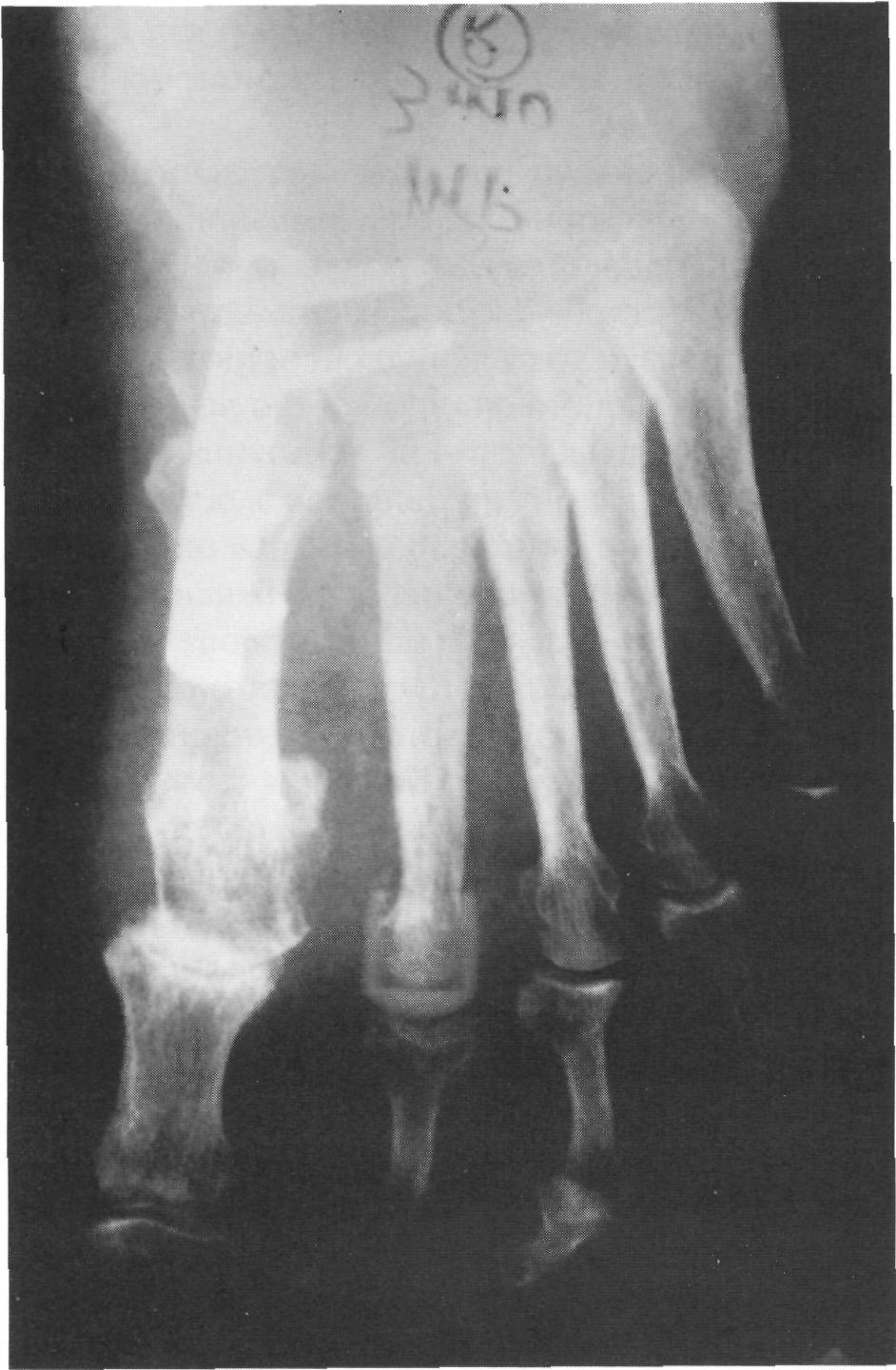 284 HALLUX VALGUS AND FOREFOOT SURGERY phase of gait.
