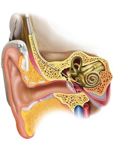 Cochlear Implant The Cochlea In the Hearing Process Cochlear implants work by imitating the natural hearing process. They convert sounds into electrical signals that are used to stimulate the cochlea.
