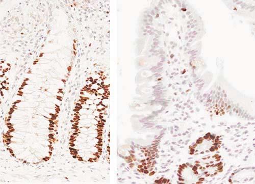(C) Section of a benign hilar stricture showing occasional Mcm2-positive cells at the base of glands. (D) Moderately to poorly differentiated cholangiocarcinoma showing high levels of Mcm2 expression.