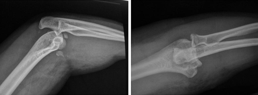 Figure 1. Frontal and lateral view revealing typical triad of the left elbow. Figure 2. Lateral and Frontal view revealing atypical triad complicated with olecranon fracture of the right elbow.