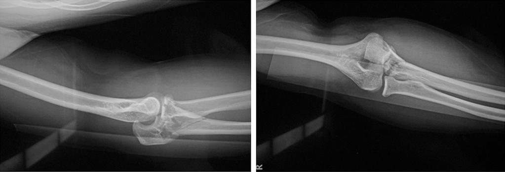 Dislocation of the right elbow joint was noted at 1 d after surgery (Figure 5).