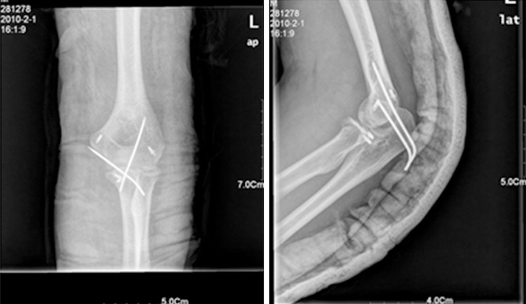 Figure 4. Frontal and Lateral view revealing the left elbow after surgery. Figure 5.