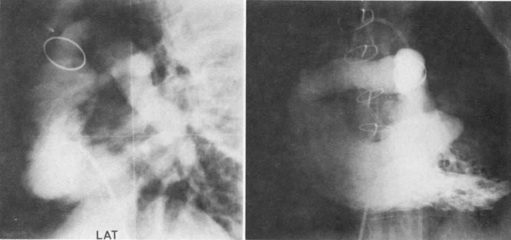 251 Mistrot et al: Tetralogy of Fallot with Single Pulmonary Artery A B Fig2. (Patient 2.) Postoperative angiograms.