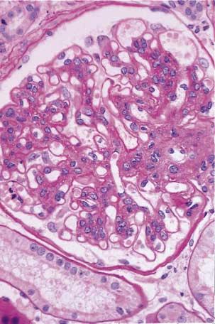 Acid Schiff, 120). Panel A shows a typical glomerulus from the base-line biopsy specimen, characterized by mild, diffuse diabetic mesangial expansion.
