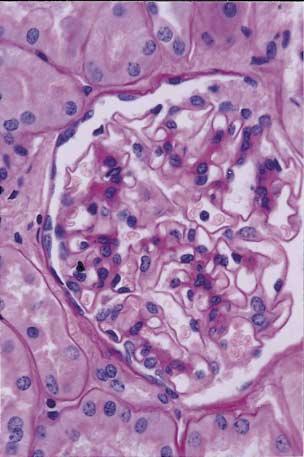 In Panel C, a typical glomerulus years after transplantation shows the reversion to nearly normal glomerular architecture. slowly become discernible.