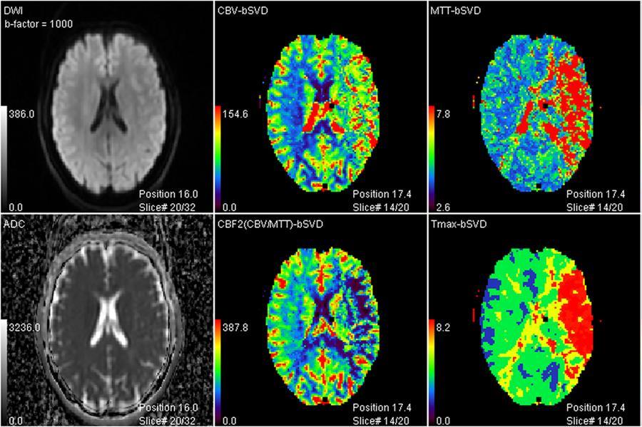 Perfusion Imaging in AIS Accurately assess dead vs. salvageable?