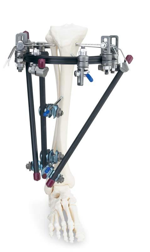 Optional Frame Configurations Frame with anterior, medial and lateral carbon fiber rods. Large multi-pin clamp frame with anterior and medial carbon fiber rods.