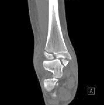 tibial fracture and the association between the triplane fracture and external rotation force.