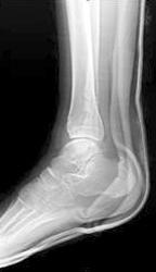 with internal rotation in cases of a lateral triplane fracture, respectively.