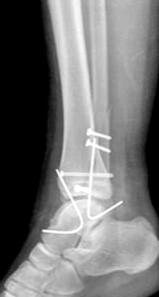In situ fixation without reduction was not performed in any of the cases.
