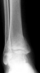 36 Fig. 2. Sixteen-yr-old boy suffered from a physeal injury of the right distal tibia.