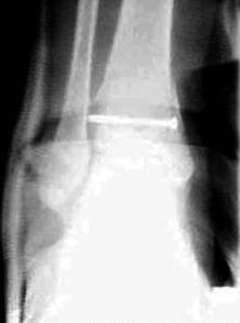 On the anteroposterior radiographs, an oblique fracture extending superomedially from an inferolateral site and from an inferomedial site in the