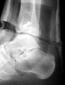 On the lateral radiographs, an oblique fracture extending from an anteroinferior site in a posterosuperior direction was observed in all 7 cases.