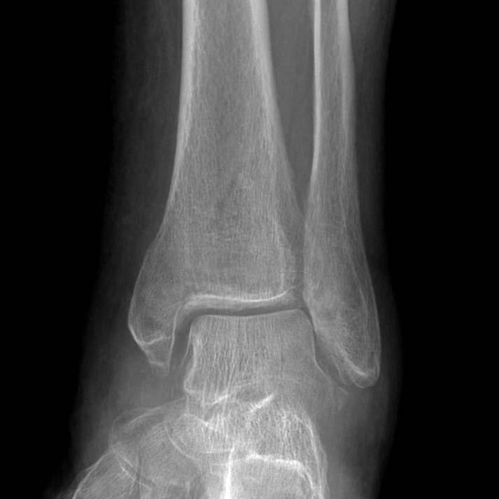Results Case 1 Nondisplaced bimalleolar fracture in a