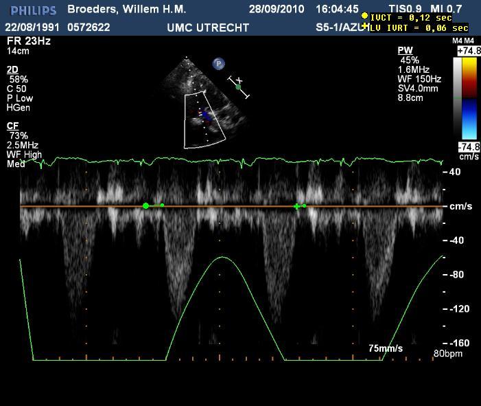 duration systole, incl IVCT &
