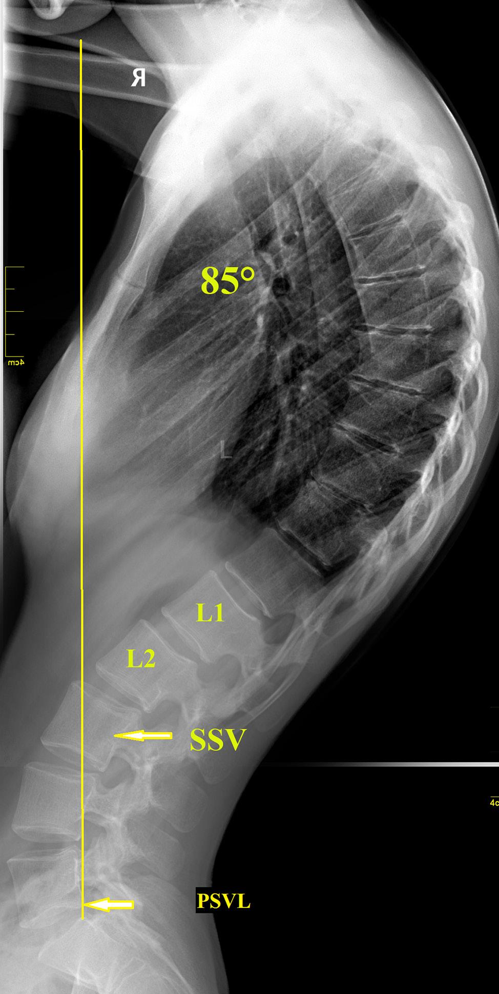 Selection of the Optimal Level of Distal Fixation for Correction of Scheuermann s Hyperkyphosis Table 3. Sagittal balance correction (mean ± SD) I (n = 29) II (n = 7) p Preoperative -0.3 ± 3.2 cm -0.