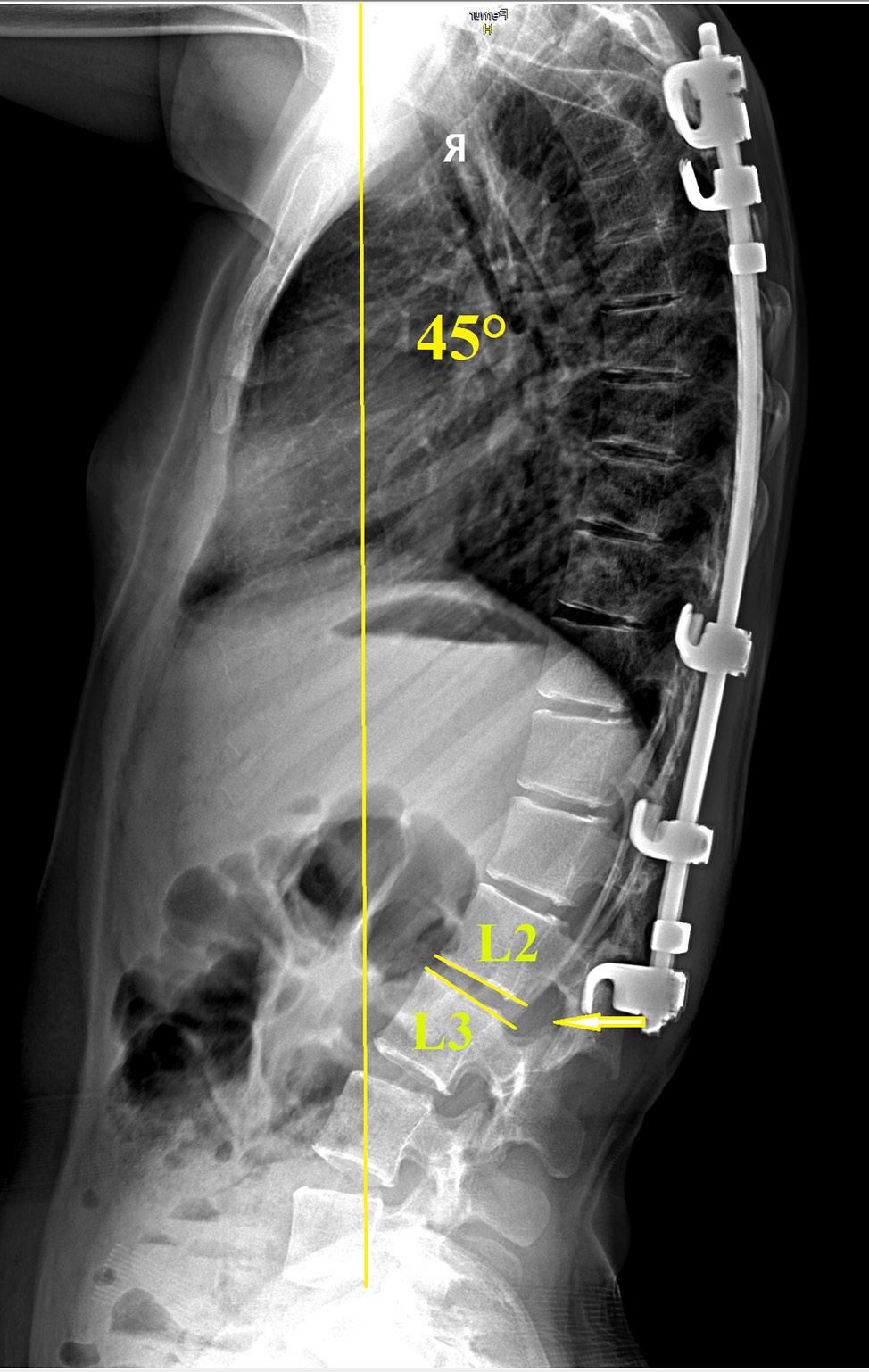 3 detected in 2 cases, requiring remounting of the instrumentation, changing hooks for transpedicular fixation, and extension of the fusion area.