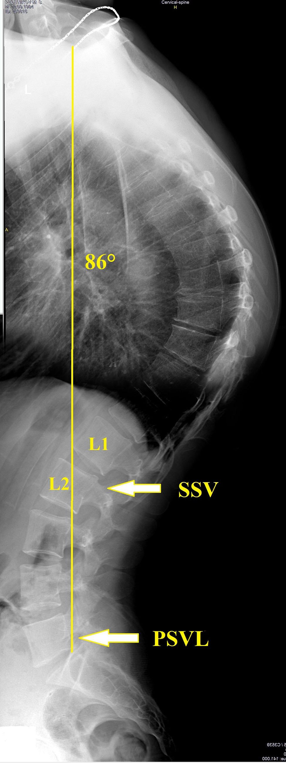 M. Mikhaylovskiy et al Figure 3. Radiographs of 25-year-old patient Sh.: posterior fusion at the T4 L2 level, sagittal stable vertebra (SSV) L2.