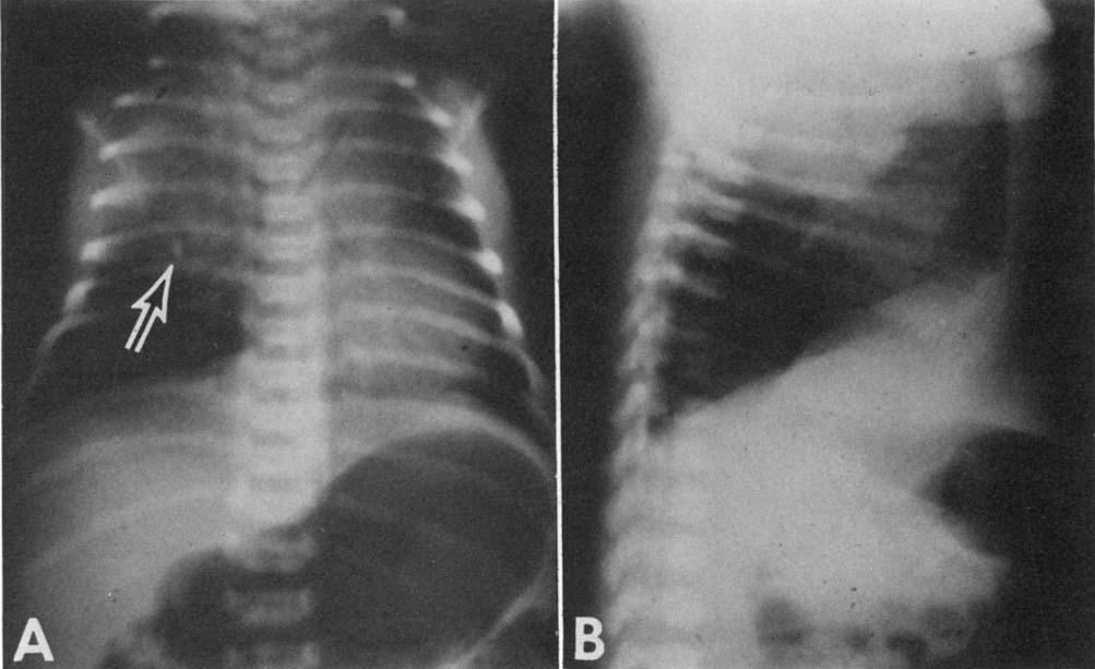 Respiratory Distress from Mediastinal Masses in Infants FIG. 2. (A) Frontal roentgenogram shows large right superior intrathoracic mass with radiopaque area characteristic of a canine tooth (arrow).
