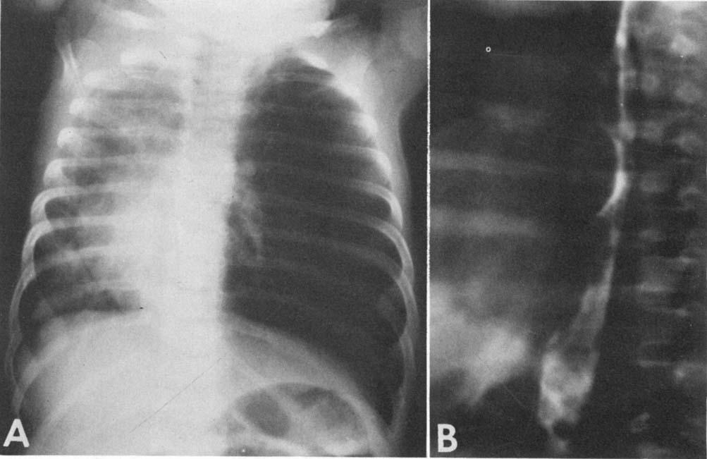 HALLER ET AL. right side, and the mediastinum was shifted to the left.