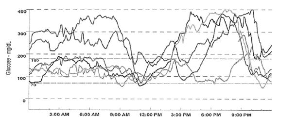 PM 12 AM Fig. 1. Continuous Glucose Monitoring Data. A, Retrospective CGM obtained during year 3 of follow-up on continuous subcutaneous insulin infusion with HbA1c 5.