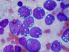 Burkitt lymphoma Monomorphic medium sized cells with finely clumped nuclei, dispersed