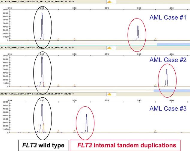 mutation when FLT3 internal tandem duplication is absent and cytogenetics are normal CEBPA mutation (correlates with erythroid differentiation and higher hemoglobin) Intermediate risk group Normal