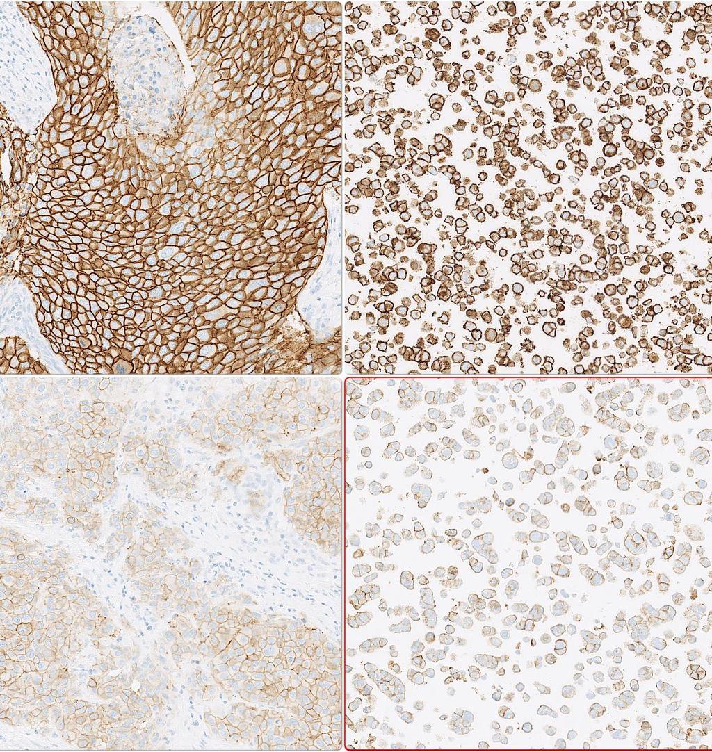 Control material for HER2 IHC: performace control / consistency Histology: 3+