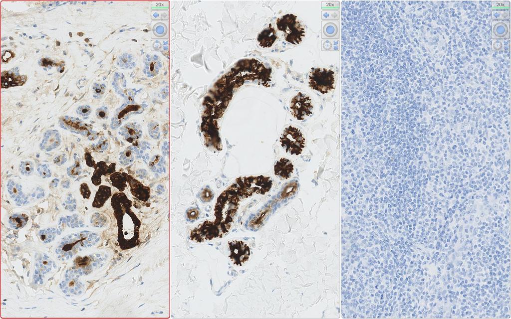 IHC Protocols and controls for Breast tumours GCDFP15 / Mammaglobin reaction pattern A moderate to strong, distinct cytoplasmic staining reaction in scattered ductal epithelial cells and in apocrine