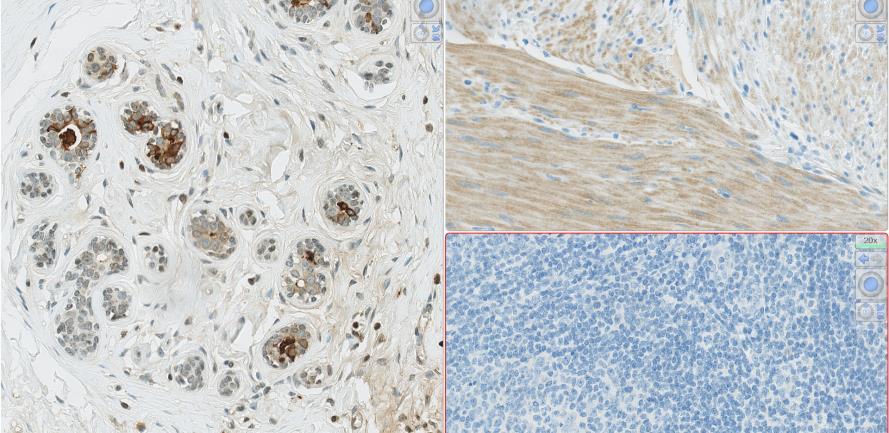 IHC Protocols and controls for Breast tumours Breast panel: GCDFP15 & Mammaglobin Basic protocol settings for an optimal staining result (NQC) Retrieval Titre Detection RTU Detection mab 23A3 HIER