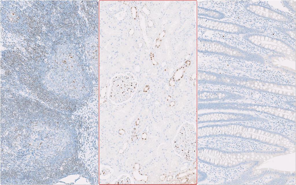 IHC Protocols and controls for Breast tumours GATA3 reaction pattern ICAPCs Tonsil Kidney App. An at least weak nuclear staining reaction of the majority of T-cells in the T-zones in the tonsil.