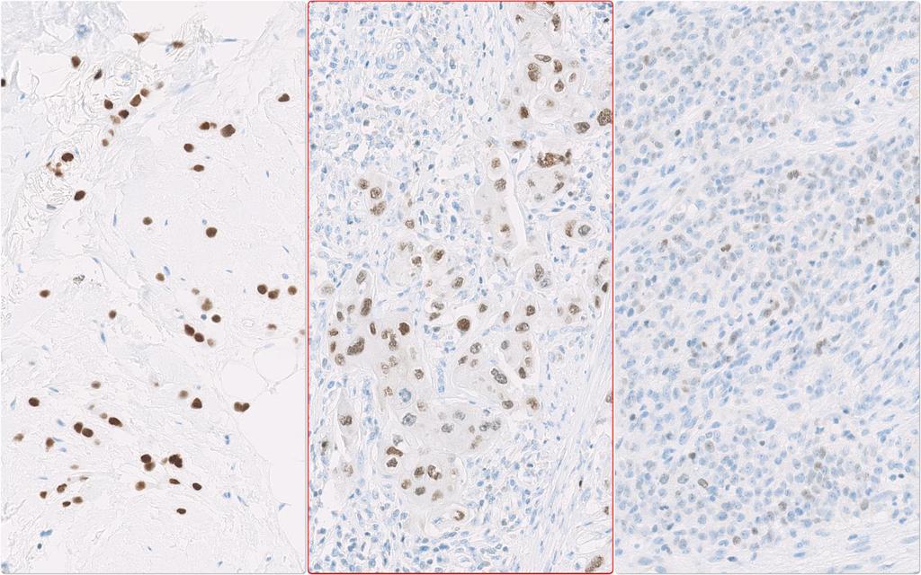 IHC Protocols and controls for Breast tumours Breast panel: GATA3 Basic protocol settings for an optimal staining result (NQC) Retrieval Titre Detection RTU Detection mab L50-8023 HIER TE