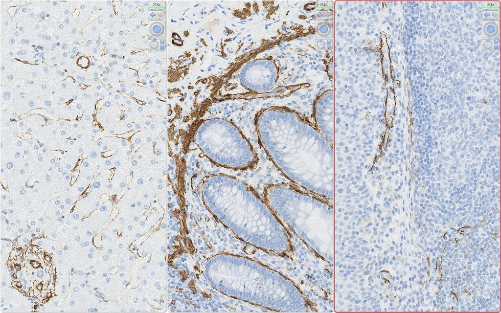 IHC Protocols and controls for Breast tumours ASMA reaction pattern ICAPCs A moderate to strong, distinct cytoplasmic staining of the majority of the perisinusoidal cells in the liver.