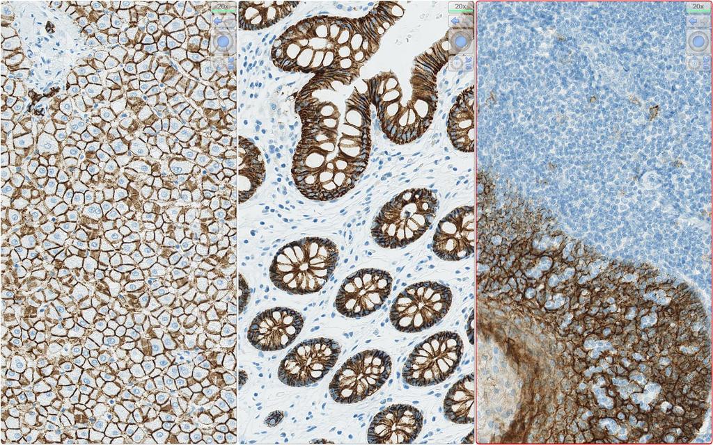 IHC Protocols and controls for Breast tumours ECAD reaction pattern ICAPCs Liver Colon Tonsil An at least weak to moderate membranous staining reaction of virtually all the hepatocytes.