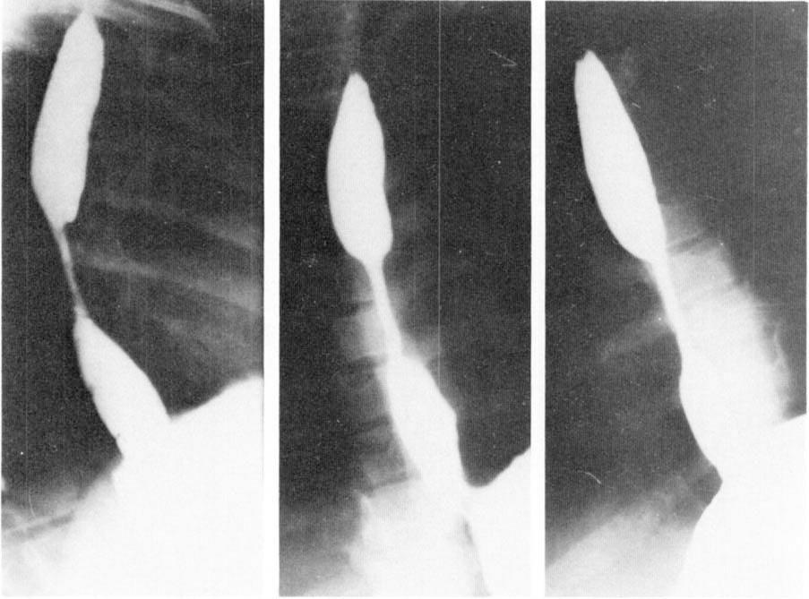 546 The Annals of Thoracic Surgery Vol 33 No 6 June 982 Fig 5.