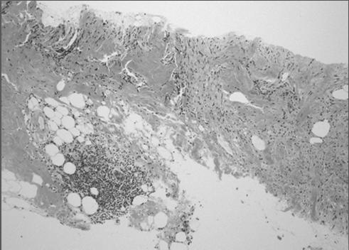 Low-grade fibromatosis-like spindle cell carcinoma