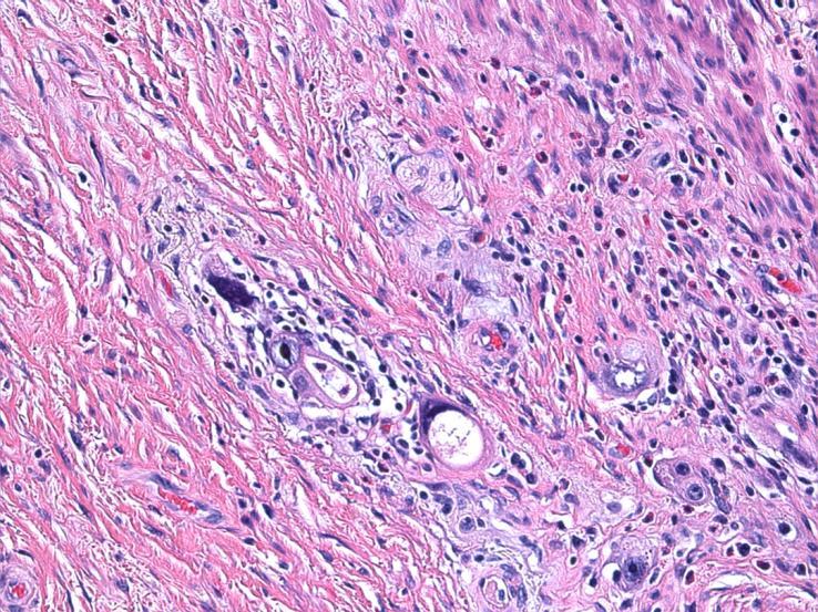 pooling macrodissected tissue from multiple levels Biopsy may be preferable to