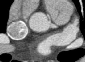 scanning, although there is a tendency to significantly increase ma in HRCT scans to increase