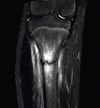 T2 FS coronal Juvenile idiopathic arthritis 14-year-old girl with bilateral stiffness in the hips. Infection MRI protocol was performed with SENSE Torso coil on Achieva 3.0T.