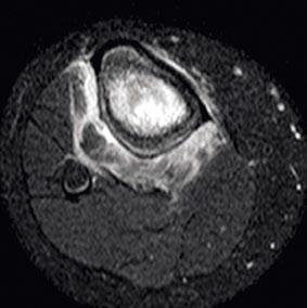 consistent with rice bodies (arrowheads). For joint-to-joint imaging, Dr. Kan typically acquires a T1-weighted scan with the Integrated Body coil.