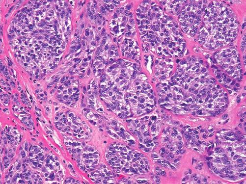 438 Melanoma FIGURE 13 Atypical compound spitzoid melanocytic neoplasm: higher magnification of deep dermal nodule.