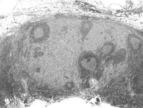 Less Common Variants of Cutaneous Melanoma 439 FIGURE 16 Melanoma resembling a Spitz tumor: sentinel lymph node (SLN) biopsy from the groin.
