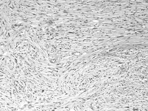 cells with stromal desmoplasia.