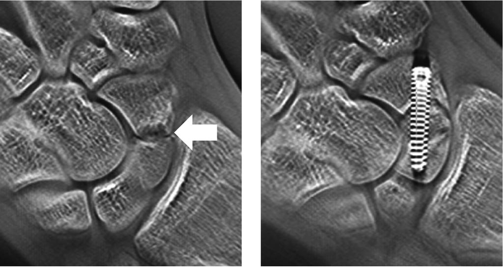 12 Frontal Tomosynthesis Image of the Cervical Vertebrae Lateral dislocation of the atlantal articular process Case 4 15-year-old male. Injured right hand in a fall from a bicycle.