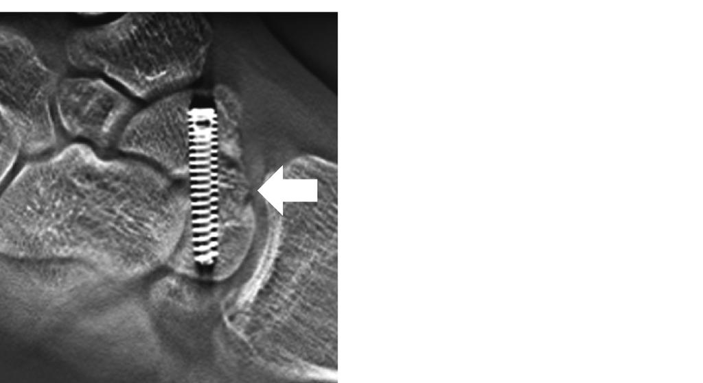 Tomosynthesis performed on arrival at the hospital confirmed a bone defect in the scaphoid waist. A bone graft with screw fixation and cast immobilization was performed two months after the injury.
