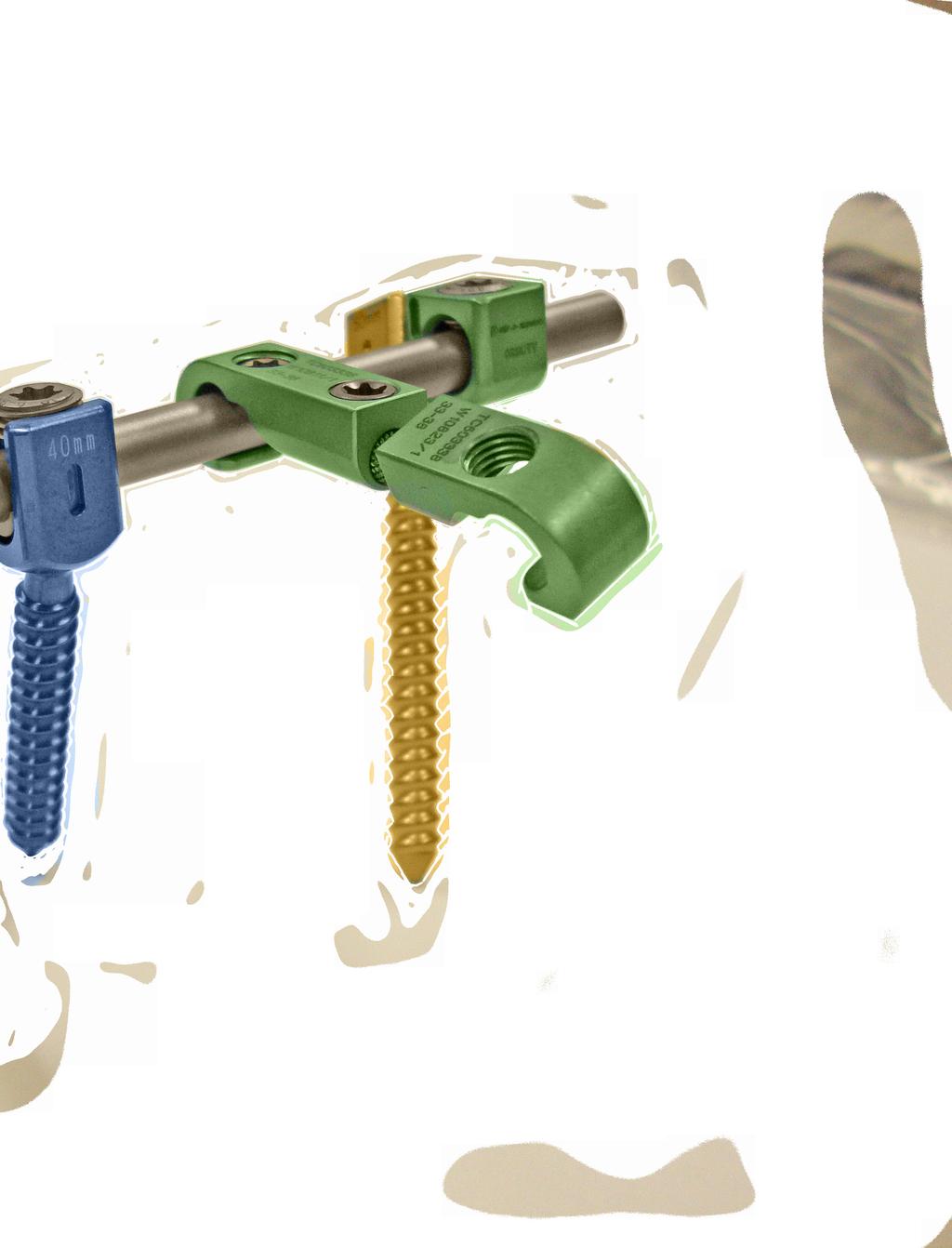 Rod/Screw Connectors Advanced Hexalobular Torx Locking System Prevent plug pop-out Eliminate chance of cross threading Secure closure with minimal torque Allow rods to be attached without