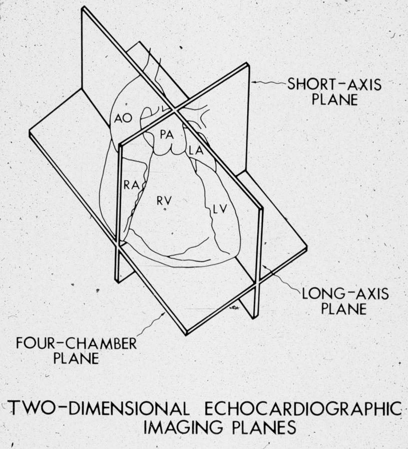 Two dimensional echo Many potentially useful planes 4 chamber
