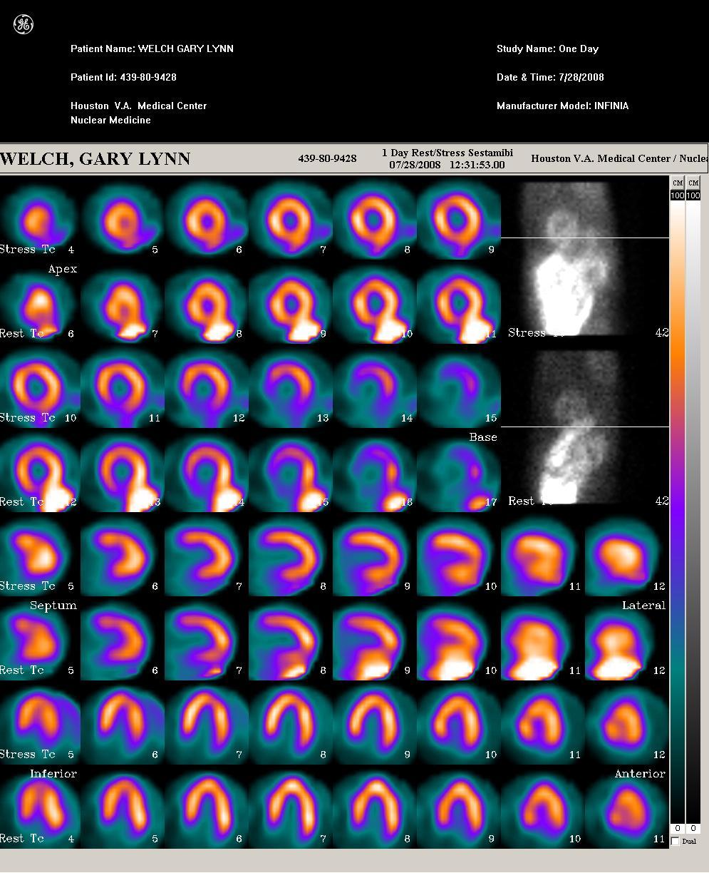 inferior (hurricane sign) vs septal / lateral, cardiac creep exercise and thallium Recognition: review raw data in cine mode Solution: reimaging, preparation and positioning, motion correction