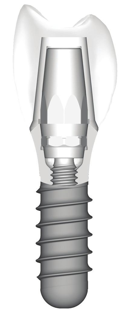 0 mm is required for an all-metal restoration (synocta cementable abutments can be shortened occlusally by a maximum of 2.