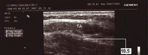 Results The Uddiyana Bandha exercise was performed by the author in a clinical setup where ultrasound